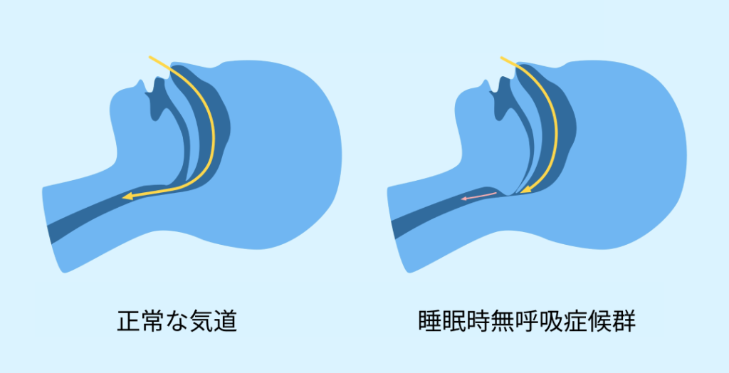 睡眠時無呼吸症候群